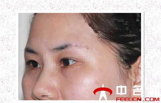 切眉一年后疤痕图片切眉者手术前不得不看的图片